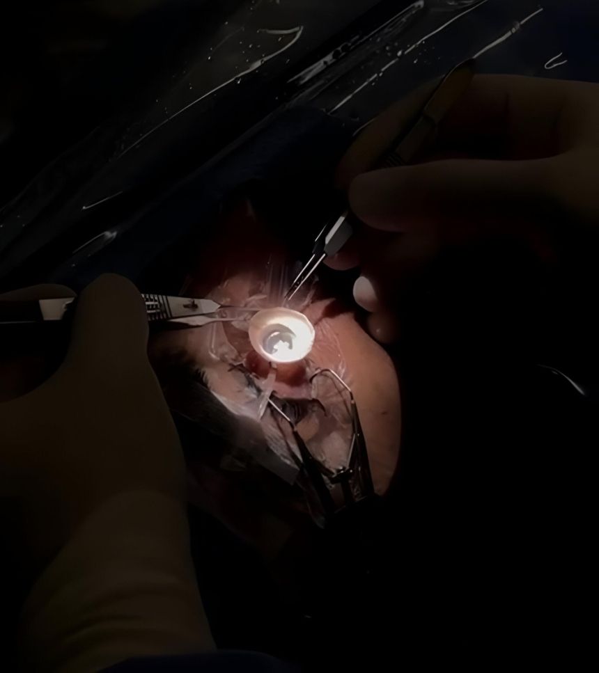 نجاح أول 5 عمليات زراعة قرنية بمدينة الملك سلمان الطبية بالمدينة