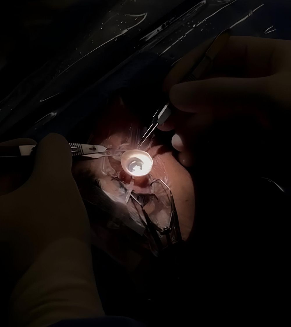 نجاح أول 5 عمليات زراعة قرنية بمدينة الملك سلمان الطبية بالمدينة