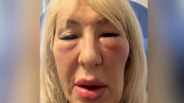 "دفعت لطبيب تجميل مزيّف آلاف الدولارات، والآن أبدو مثل الوحش"