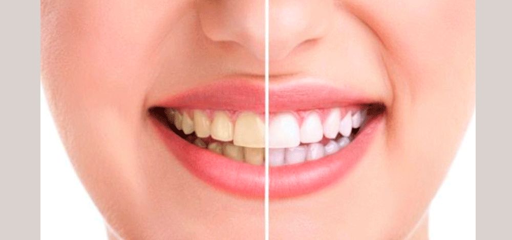 الامارات | نصيحة عملية للتخلص من اصفرار الأسنان