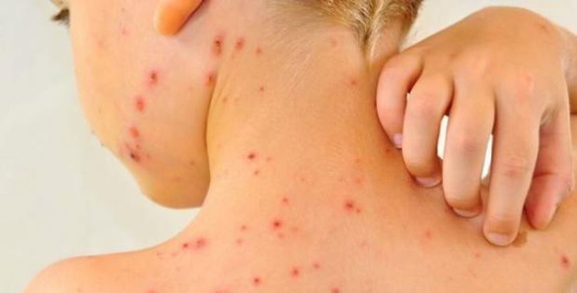 أعراض جدري القردة عند الأطفال بعد تسجيل 800 حالة اشتباه في الكونغو