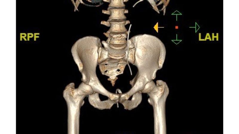 الامارات | مريض يعاني «دعامة مُهمَلة» في حالبه منذ 5 سنوات