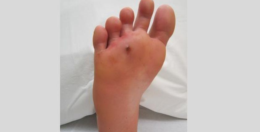 هل دواء السكري يسبب النقرس؟.. احذر هذا الأمر