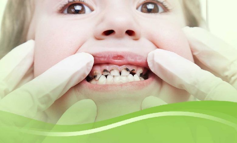 تعرف على وصفة طبيعية للتخلص من تسوّس الأسنان نهائيا ودون أدوية