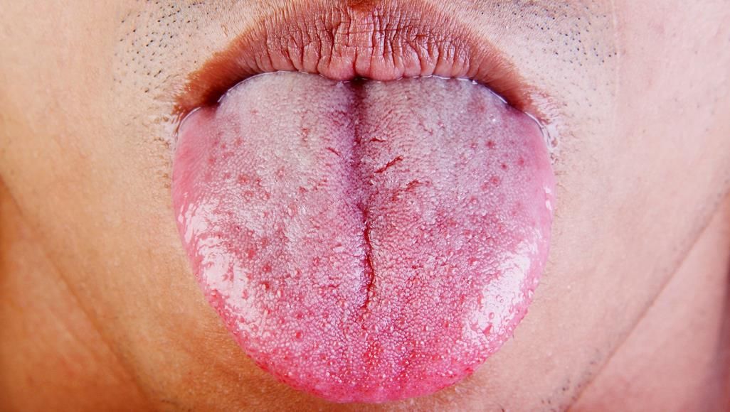 الامارات | إلى ماذا يشير لون اللسان؟