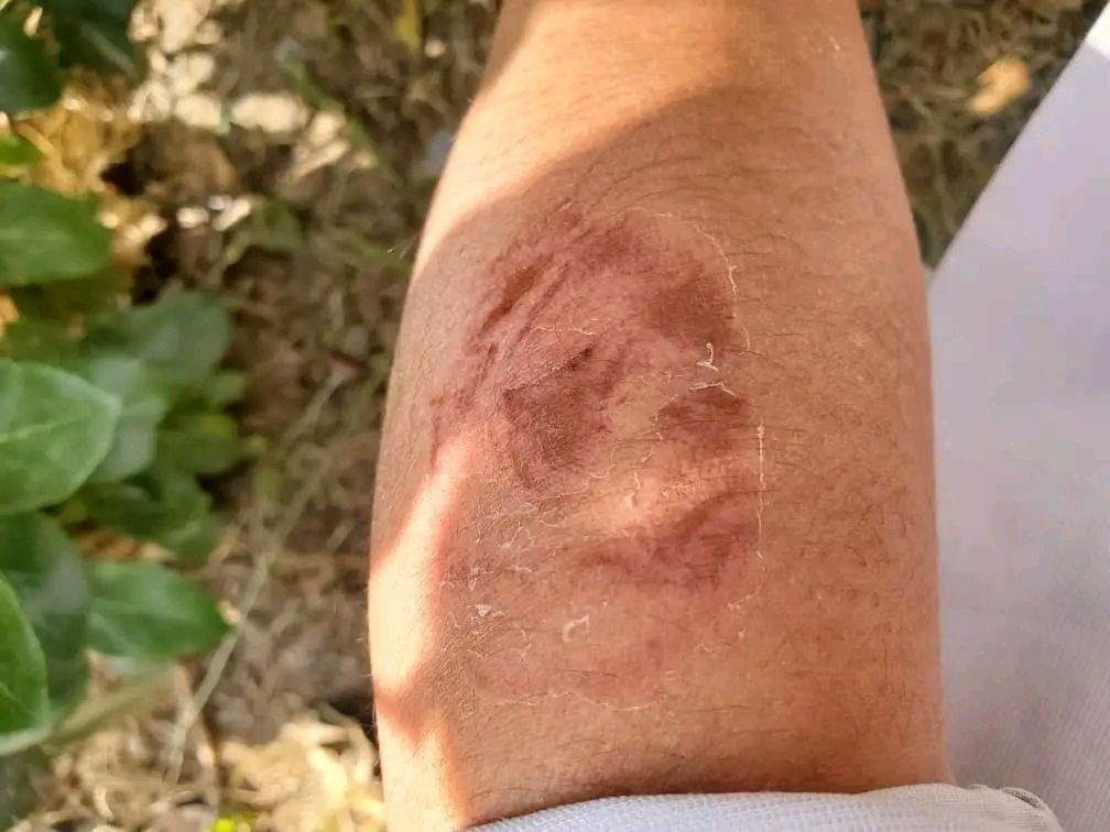 أنثى حمار تعض شابًا في إب وتصيبه بجروح