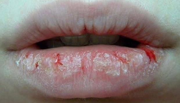 روشتة هاني الناظر للتعامل مع أيام البرد الشديد.. تخلصي من التشققات