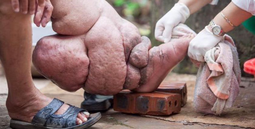 بعد القضاء عليه في مصر رسميًا.. ما هو مرض الفيلاريات اللمفية «داء الفيل»؟