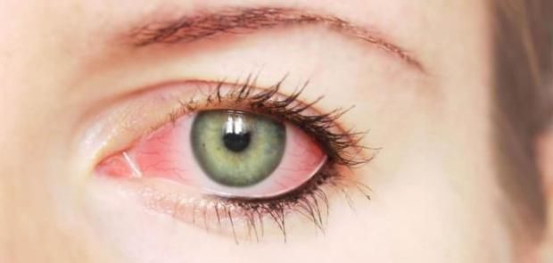 ما هو داء كلابية الذنب المسبب للعمى؟.. ينتقل عن طريق لدغة الذبابة السوداء 