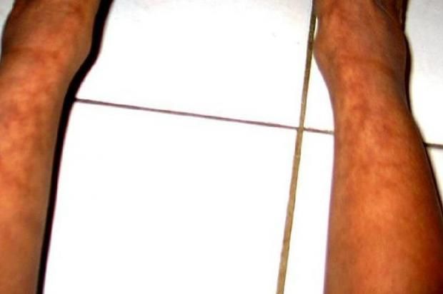 تحذير من استخدام اللاب توب بهذه الطريقة.. تسبب متلازمة الجلد المحمص