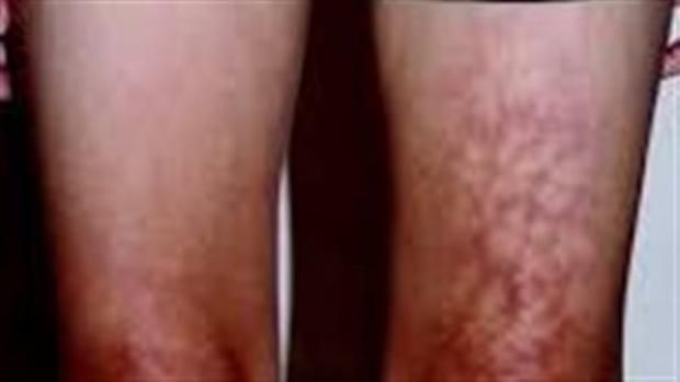 تحذير من استخدام اللاب توب بهذه الطريقة.. تسبب متلازمة الجلد المحمص