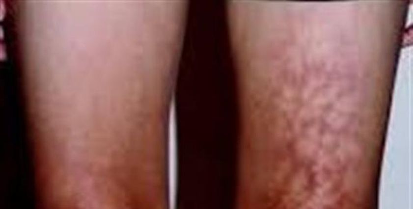 تحذير من استخدام اللاب توب بهذه الطريقة.. تسبب متلازمة الجلد المحمص