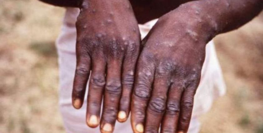 بعد كورونا.. هل يواجه العالم جائحة جديدة بسبب جدري القرود القاتل؟