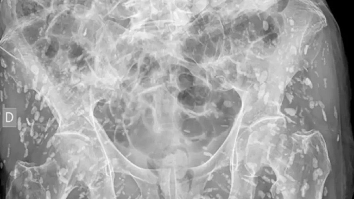 الامارات | طبيب ينشر صورة صادمة لرجل تغزو جسده الديدان الشريطية: الخطورة في وصولها للمخ