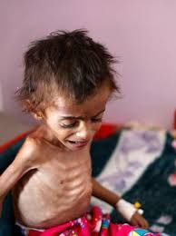 المملكة تعترف: تسببنا في تفاقم المجاعة في اليمن