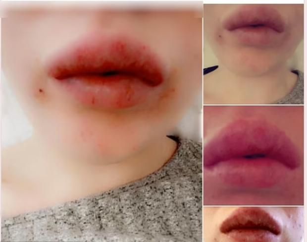 متى يؤدي فيلر الشفاه إلى فقدان البصر؟.. أطباء يحذرون