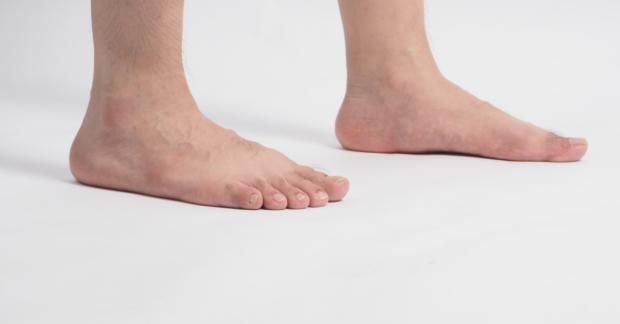 مرض القدم المسطحة.. ما هو الفلات فوت وأعراضه وطرق علاجه؟