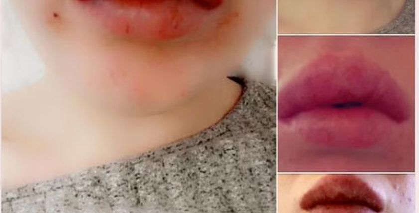 متى يؤدي فيلر الشفاه إلى فقدان البصر؟.. أطباء يحذرون