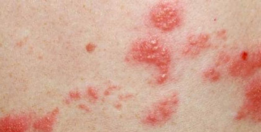 الحزام الناري يهاجم مليون شخص سنويا.. اعرف أعراضه وطرق الوقاية 