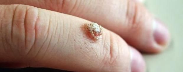 السنط الجلدي وخطورته على النساء.. هل يصل لسرطان عنق الرحم؟