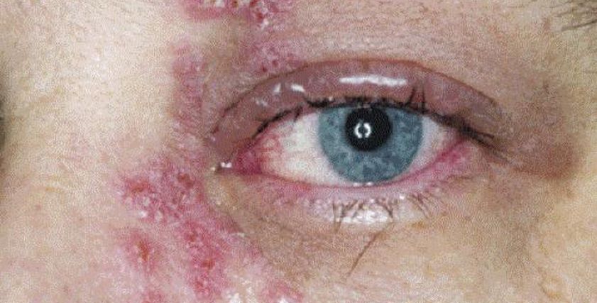 تطعيم الحزام الناري في مصر.. كل ما تريد معرفته عن الجرعات والفئات المستهدفة