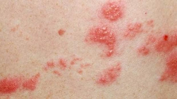 تطعيم الحزام الناري في مصر.. كل ما تريد معرفته عن الجرعات والفئات المستهدفة