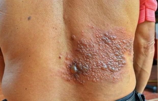 تطعيم الحزام الناري في مصر.. كل ما تريد معرفته عن الجرعات والفئات المستهدفة