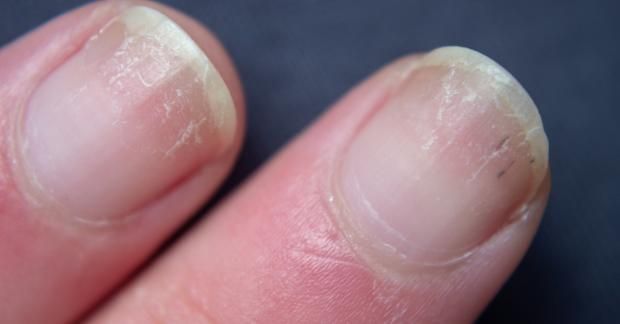 علامات في الأظافر تشير للإصابة بأمراض القلب والكبد.. لا تهملها