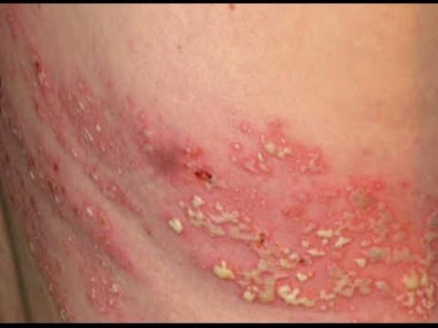 تطعيم الحزام الناري في مصر.. كل ما تريد معرفته عن الجرعات والفئات المستهدفة