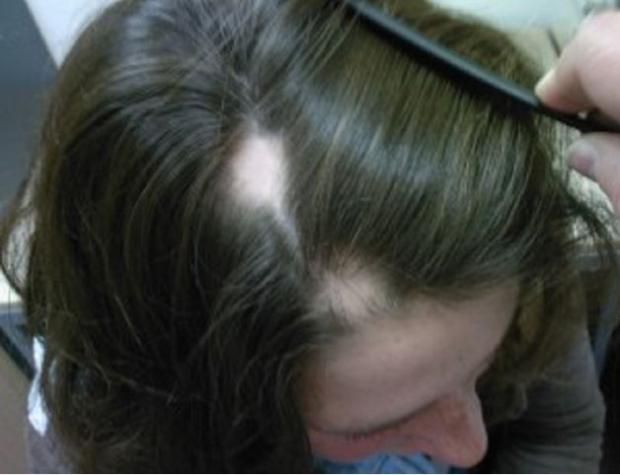 طرق علاج الثعلبة بالزيوت الطبيعية والدواء.. طبيبة تعيد الأمل