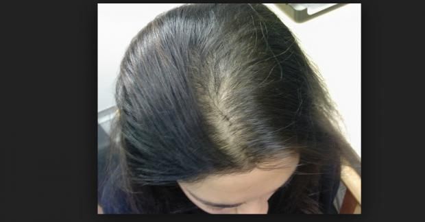 طرق علاج الثعلبة بالزيوت الطبيعية والدواء.. طبيبة تعيد الأمل