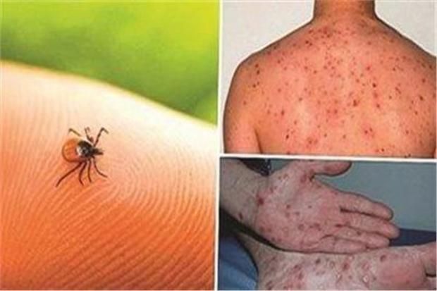 انتشار حمى الضنك النزفية في إندونيسيا بسبب الأمطار.. إليك الأعراض وطرق الوقاية