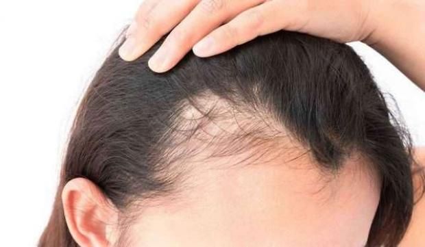 طرق علاج الثعلبة بالزيوت الطبيعية والدواء.. طبيبة تعيد الأمل