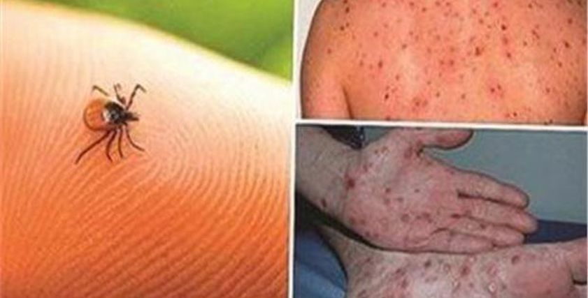 انتشار حمى الضنك النزفية في إندونيسيا بسبب الأمطار.. إليك الأعراض وطرق الوقاية