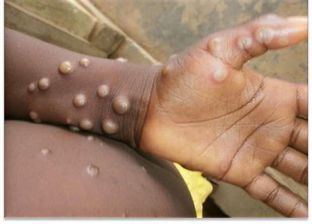 بعد تسجيل الإمارات أول إصابة.. ماذا تعرف عن سلالة Ib MPXV من جدري القرود؟