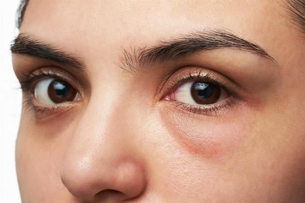 طبيب يكشف طريقة فعالة لعلاج الجيوب الأنفية في الشتاء