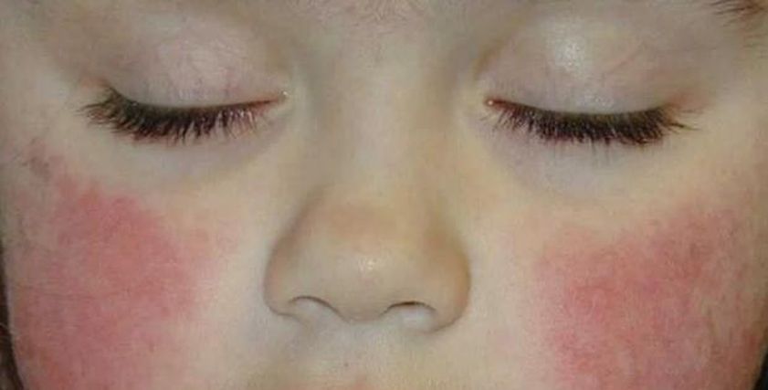 طفلك عنده حساسية؟.. اعرفي الأنواع الشائعة وإزاي تتعاملي معاها