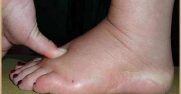 تورم القدمين في أثناء الحمل.. كيفية التعامل معها وتخفيف الألم؟