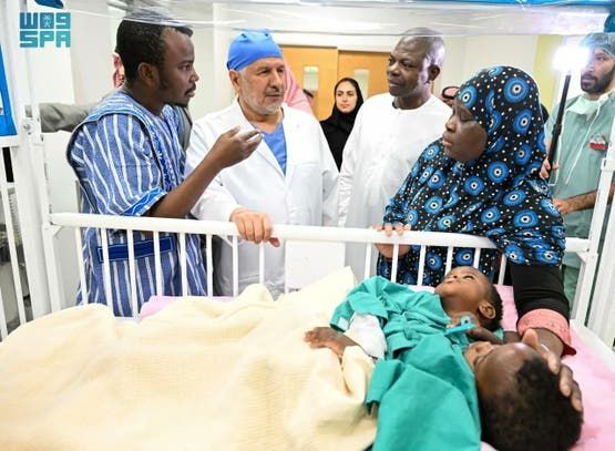 الخليج اليوم .. نجاح عملية فصل التوأم السيامي البوركيني "حوى وخديجة"