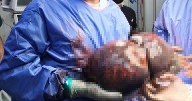 فريق طبى بمستشفى الحسين ينجح فى إجراء عملية دقيقة لاستئصال ورم كبير بالطحال