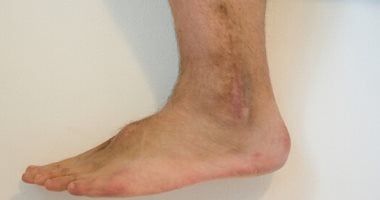 إصابات الملاعب.. "الالتواء" الإصابة الأكثر شيوعاً بين الرياضيين