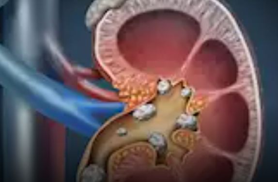 صحتك في رمضان.. 5 عادات بسيطة قد تمنع حصوات الكلى