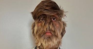 هندى يدخل موسوعة جينيس لإصابته بـ"متلازمة المستذئب".. وجهه مغطى بالشعر