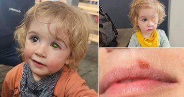 طفل بريطانى يفقد عينه بسبب قبلة بعد انتقال عدوى من شخص مصاب بفيروس الهربس