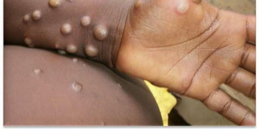 جدري القرود يعود بسلالة قاتلة تهدد العالم.. تحذير جديد من «الصحة العالمية»