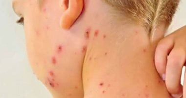 الصحة العالمية: الحصبة تُشكل تهديدا عالميا وتسجيل 127350 إصابة فى أوروبا