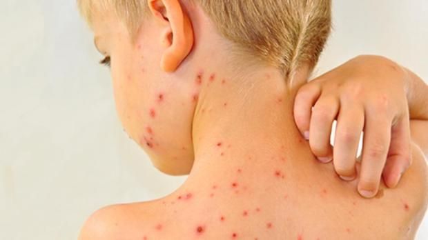 أعراض الحصبة وطرق العدوى.. تزايد مرعب في الإصابات داخل أوروبا