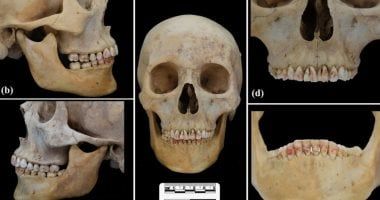 تكنولوجيا: اكتشاف مقبرة صينية عمرها 2.200 عام يظهر امرأة بأسنان مغطاة بمعدن سام