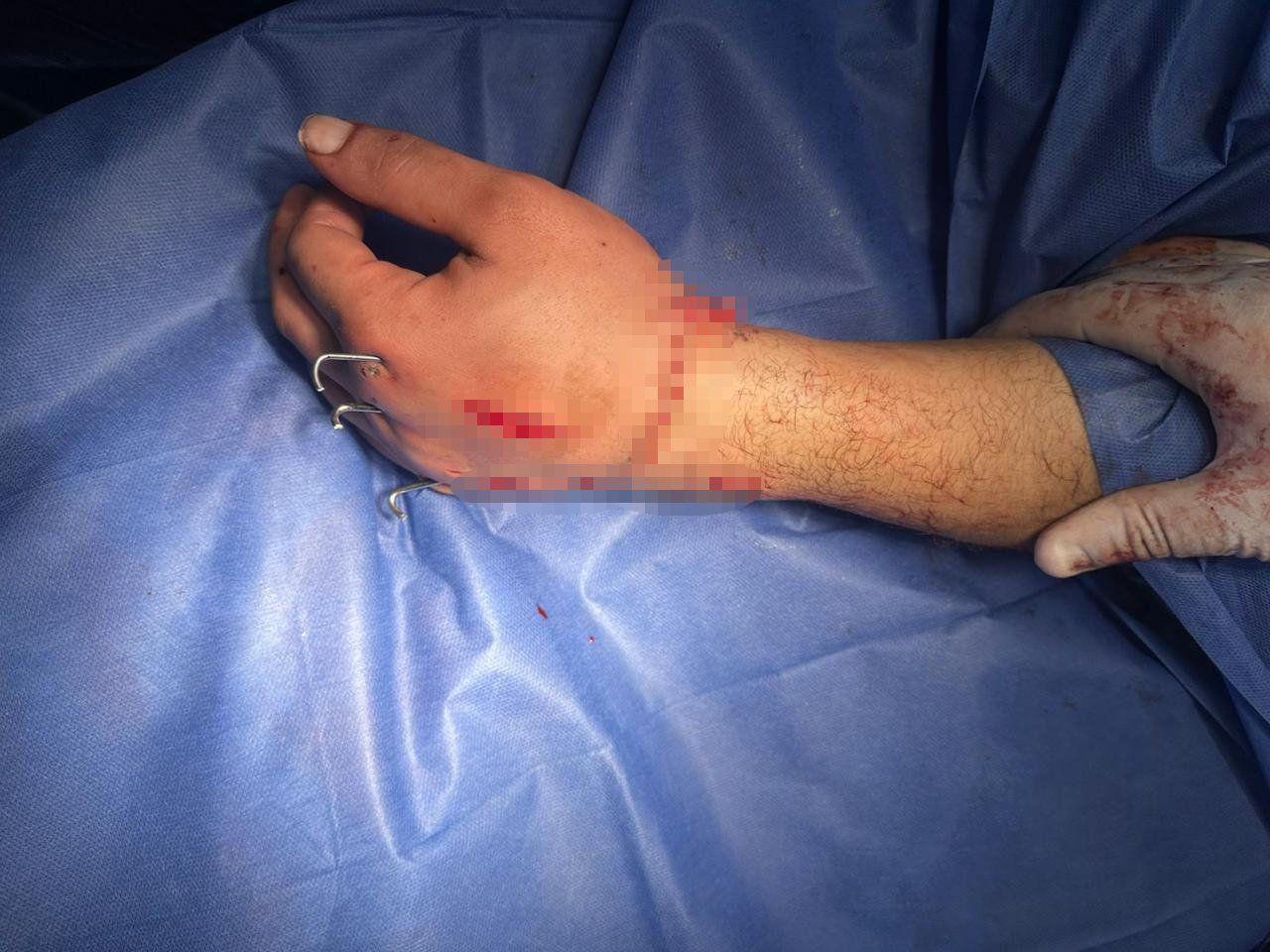 نجاح جراحة زراعة يد مبتورة لمريض فى مستشفى الطوارئ بقصر العينى