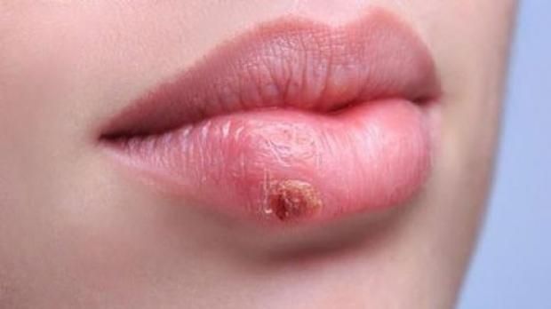 متى يتحول الهربس إلى خطر صحي حقيقي؟ طبيب يحذر من المضاعفات الخطيرة